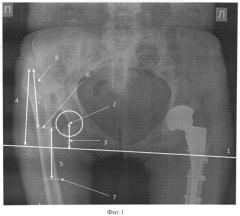 Способ эндопротезирования тазобедренного сустава с использованием корригирующей остеотомии (патент 2533971)