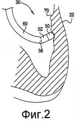 Дисплей катетера, показывающий угол наклона и давление (патент 2574369)