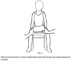 Способ лечения подвывиха бедра и аддукторного синдрома у детей (патент 2448672)