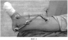 Способ восстановления целостности и функциональности пяточной кости человека и аппарат для его осуществления (патент 2566663)