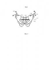 Способ использования оптической медицинской навигационной системы для визуализации и количественной оценки качества репозиции отломков при переломе кости таза (патент 2635451)