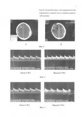 Способ лечения больных с посттравматическим поражением головного мозга в раннем периоде заболевания (патент 2666121)