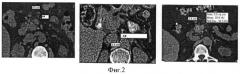 Способ динамической оценки структурных изменений паренхимы поджелудочной железы (патент 2501527)