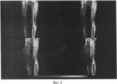 Способ лечения облитерирующего атеросклероза сосудов нижних конечностей (патент 2361527)