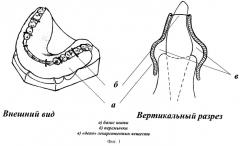 Способ изготовления лечебно-профилактической зубодесневой шины (патент 2249441)