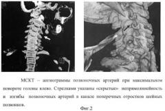 Способ позиционной мультиспиральной кт-ангиографии в экспертной оценке состояния позвоночных артерий у больных с дорсопатией шейного отдела позвоночника и с синдромом недостаточности кровообращения в вертебро-базилярной системе (патент 2398503)