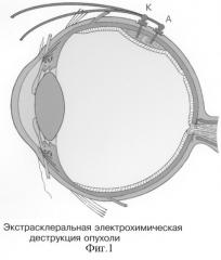 Способ хирургической электрохимической деструкции и фотодинамического лечения внутриглазных новообразований (патент 2243755)