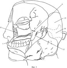 Способ хирургического доступа к опухолям подвисочной, крыло-небной ямок, крыловидно-челюстного пространства и носоглотки (патент 2445004)