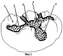 Способ пломбирования кариозной полости (патент 2285496)