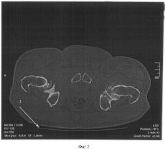 Способ оценки положения проксимального отдела бедренной кости (патент 2493774)
