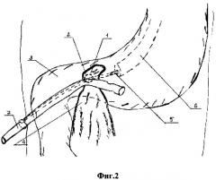 Способ эндоскопической оментопластики перфоративных гастродуоденальных язв (патент 2294170)