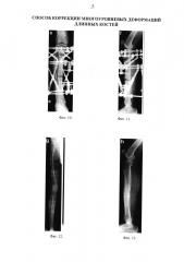 Способ коррекции многоуровневых деформаций длинных костей (патент 2640999)