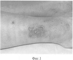 Способ лечения больных с недостаточностью клапанов перфорантных вен голени, осложненной трофическими язвами (патент 2328997)