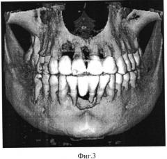 Способ восстановления тканей зубочелюстной системы (патент 2551312)