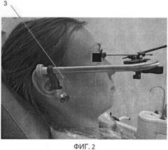 Способ диагностики зубочелюстной системы с учетом оси головки нижней челюсти и устройства для его реализации (патент 2461367)