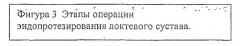 Способ лечения тяжелых внутрисуставных переломов локтевого сустава (патент 2463980)