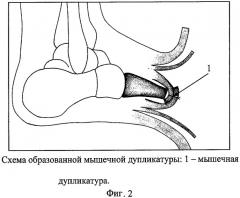 Способ формирования культи стопы (патент 2308244)