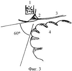Способ доступа к субтенториальным менингиомам латеральных отделов мозжечкового намета и перехода поперечного синуса в сигмовидный синус (патент 2364345)