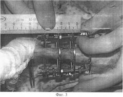Способ моделирования ложного сустава при переломе костей голени и устройство для его осуществления (патент 2523622)