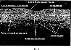 Способ оценки эффективности лечения макулярного разрыва (патент 2277843)