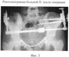 Способ лечения повреждений таза с нарушением целостности переднего и заднего его отделов (патент 2364359)