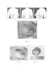 Способ одномоментной реконструкции молочной железы при органосохраняющем хирургическом лечении рака при локализации опухоли в наружных квадрантах (патент 2623453)