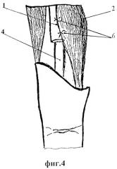 Способ тендопластики глубокого сгибателя пальца (патент 2322952)