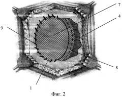 Способ пластики послеоперационных вентральных грыж (патент 2270614)