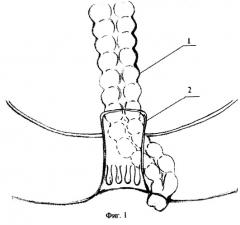Способ восстановления непрерывности толстой кишки (патент 2261053)