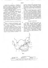 Устройство для замещения полного дефекта обеих верхних челюстей (патент 1586697)