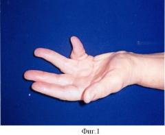 Способ лечения сгибательно-разгибательной контрактуры пальцев кисти (патент 2421169)
