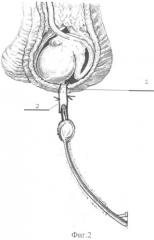 Способ закрытой фиксации яичка в мошонке при орхиопексии (патент 2502476)