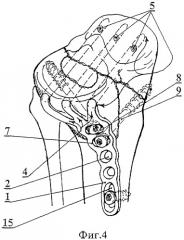 Вильчатая пластинка для остеосинтеза переломов мыщелков большеберцовой кости (патент 2312634)