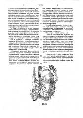 Способ проксимальной резекции желудка при язвах (патент 1734704)