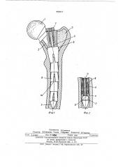 Протез головки тазобедренного сустава (патент 483817)