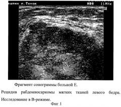 Способ ультразвуковой диагностики рецидивов мягкотканых сарком и фиброзных изменений (патент 2311129)