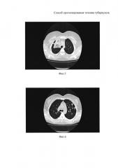 Способ прогнозирования течения туберкулеза (патент 2613320)