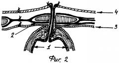 Способ наложения постоянной гастростомы из слизистой желудка (патент 2308895)