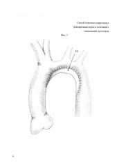 Способ пластики коарктации и рекоарктации аорты в сочетании с гипоплазией дуги аорты (патент 2621953)
