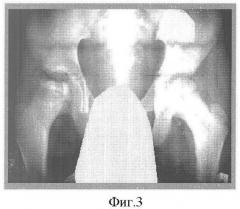 Способ лечения асептического некроза головки бедренной кости и болезни пертеса (патент 2357736)