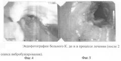 Способ вибробужирования стенозов гортани и трахеи (патент 2292848)