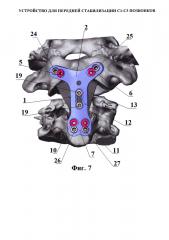 Устройство для передней стабилизации с1-с3 позвонков (патент 2615901)