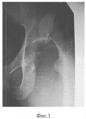Способ эндопротезирования тазобедренного сустава при переломах и посттравматических дефектах вертлужной впадины (патент 2360627)