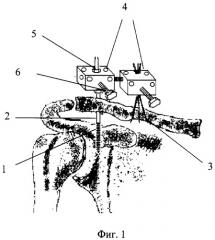 Способ чрескостного остеосинтеза переломовывихов акромиального конца ключицы (патент 2299701)