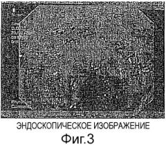 Твердая композиция для перорального введения красителей и их диагностическое применение (патент 2561034)