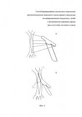 Способ формирования дистального анастомоза при реконструкции выводного отдела правого желудочка экстракардиальным кондуитом у детей с врожденными пороками сердца при отсутствии легочного ствола (патент 2644937)