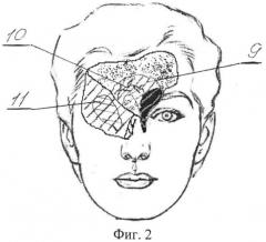 Способ устранения сквозного дефекта носо-лобно-орбитальной области (патент 2525017)