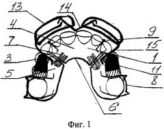 Аппарат для лечения гнатической формы мезиальной окклюзии у подростков (патент 2547789)