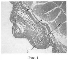 Инъекционный гетерогенный биополимерный гидрогель для заместительной и регенеративной хирургии и способ его получения (патент 2433828)