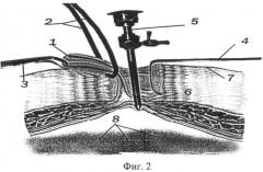 Способ введения первого троакара при лапароскопии у пациентов с ожирением iii-iv степени (патент 2513137)